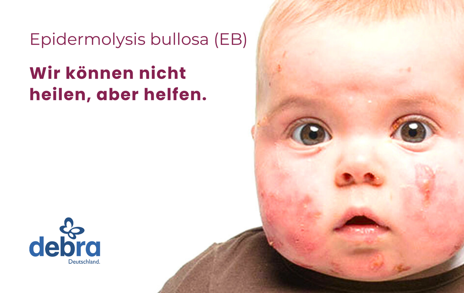 Unterstützung, Aufklärung Und Austausch Für Menschen Mit Epidermolysis ...